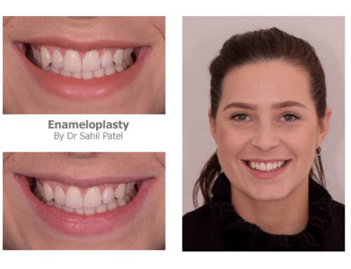 Tooth Contouring 06