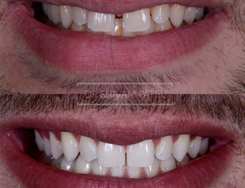 Invisalign 2