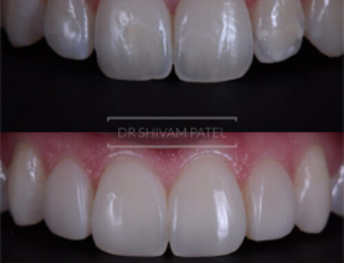Composite Veneers 6