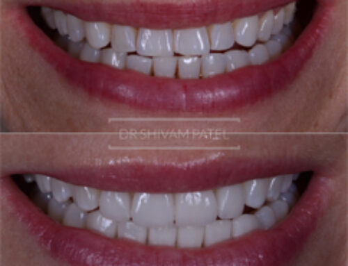 Composite Veneers 7