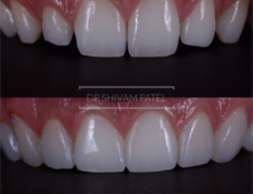 Composite Veneers 4